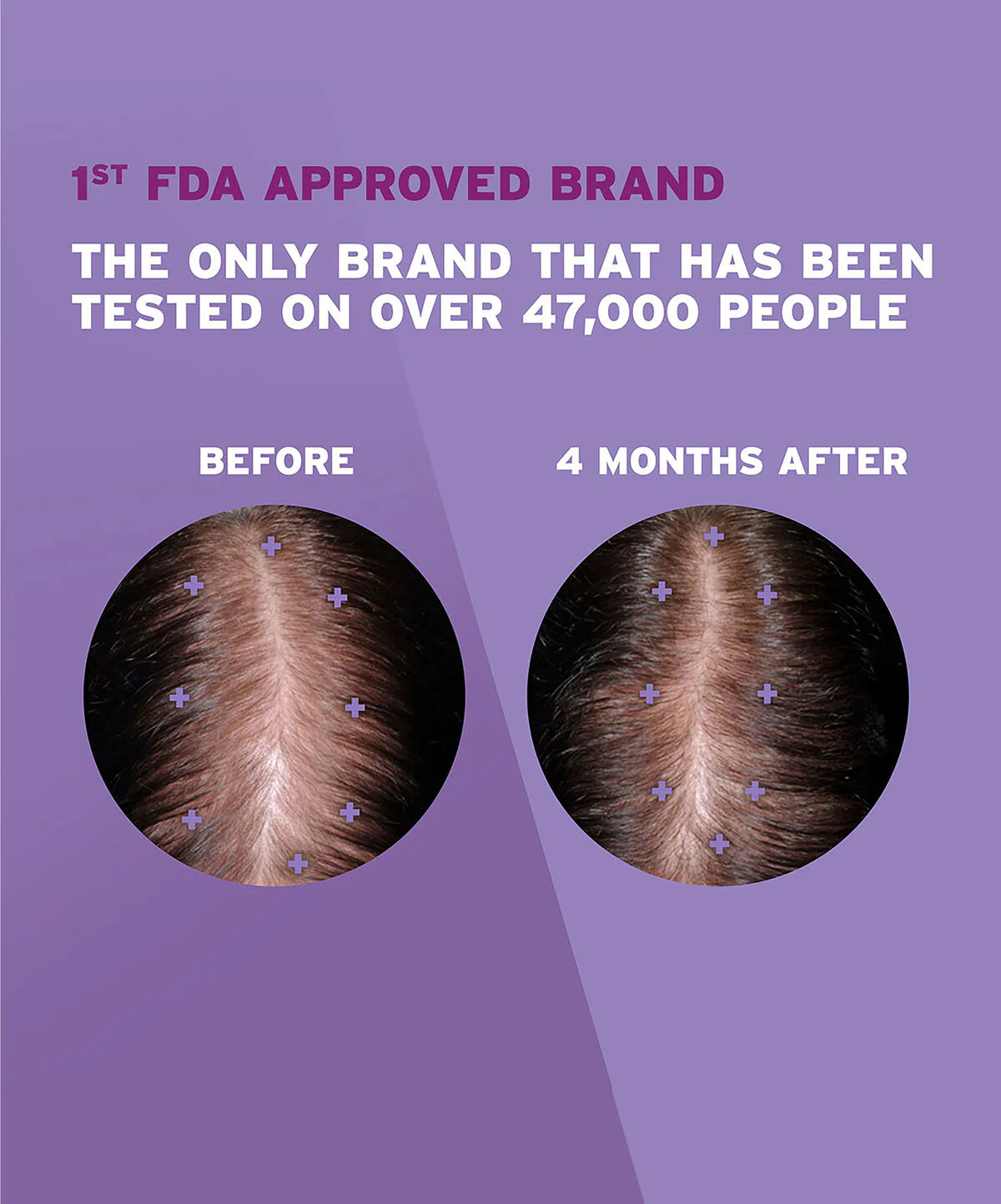 Womens ROGAINE® 5% Minoxidil Unscented Foam